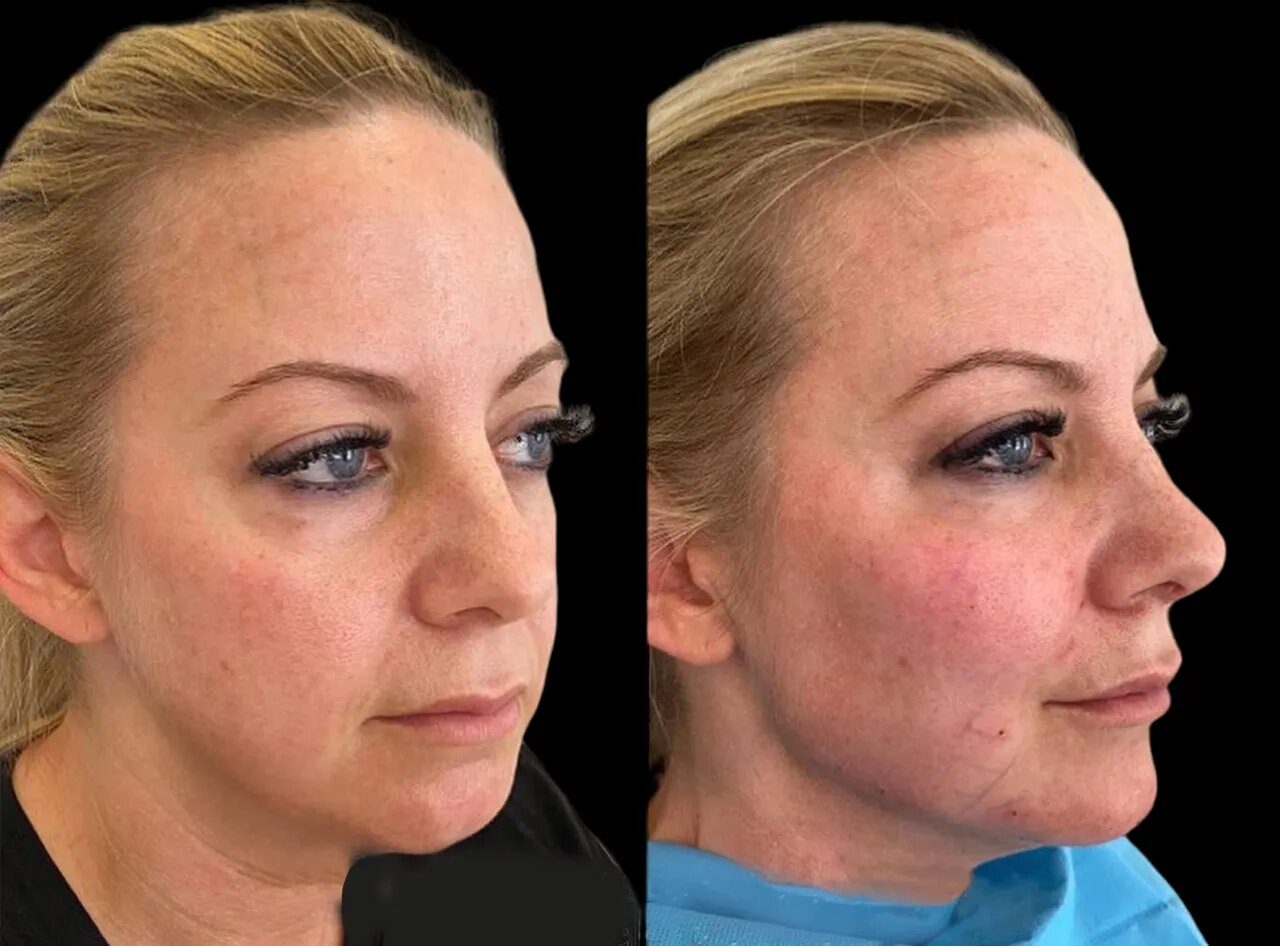 Why the Best Aesthetic Clinics in Dubai Provide the Most Professional Cheek Fillers Results