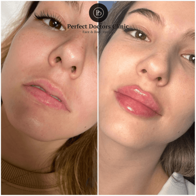 Copy-of-lip-filler-1