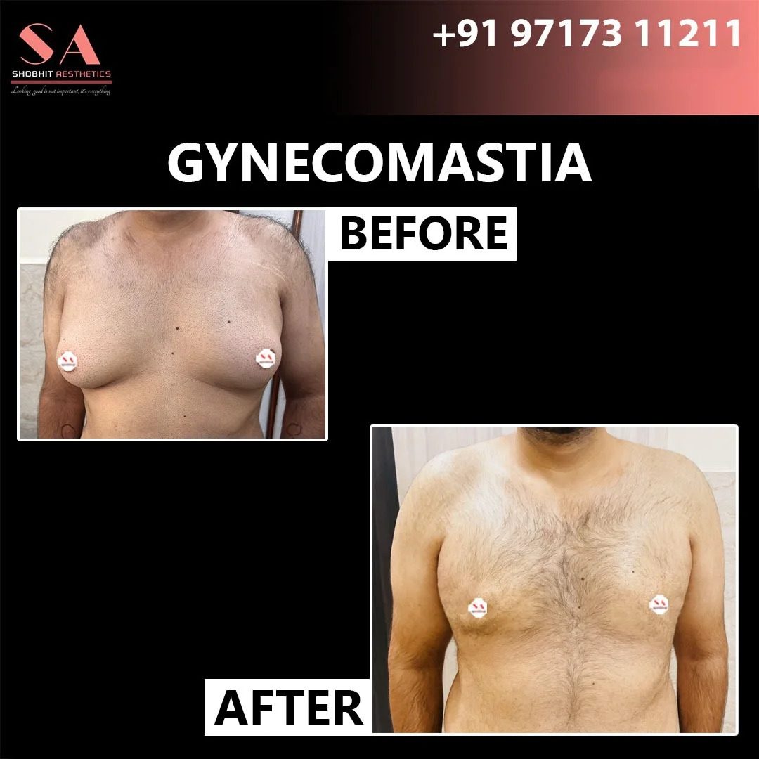 Transform Your Confidence with Expert Gynecomastia Surgery in Delhi by Dr. Shobhit Gupta