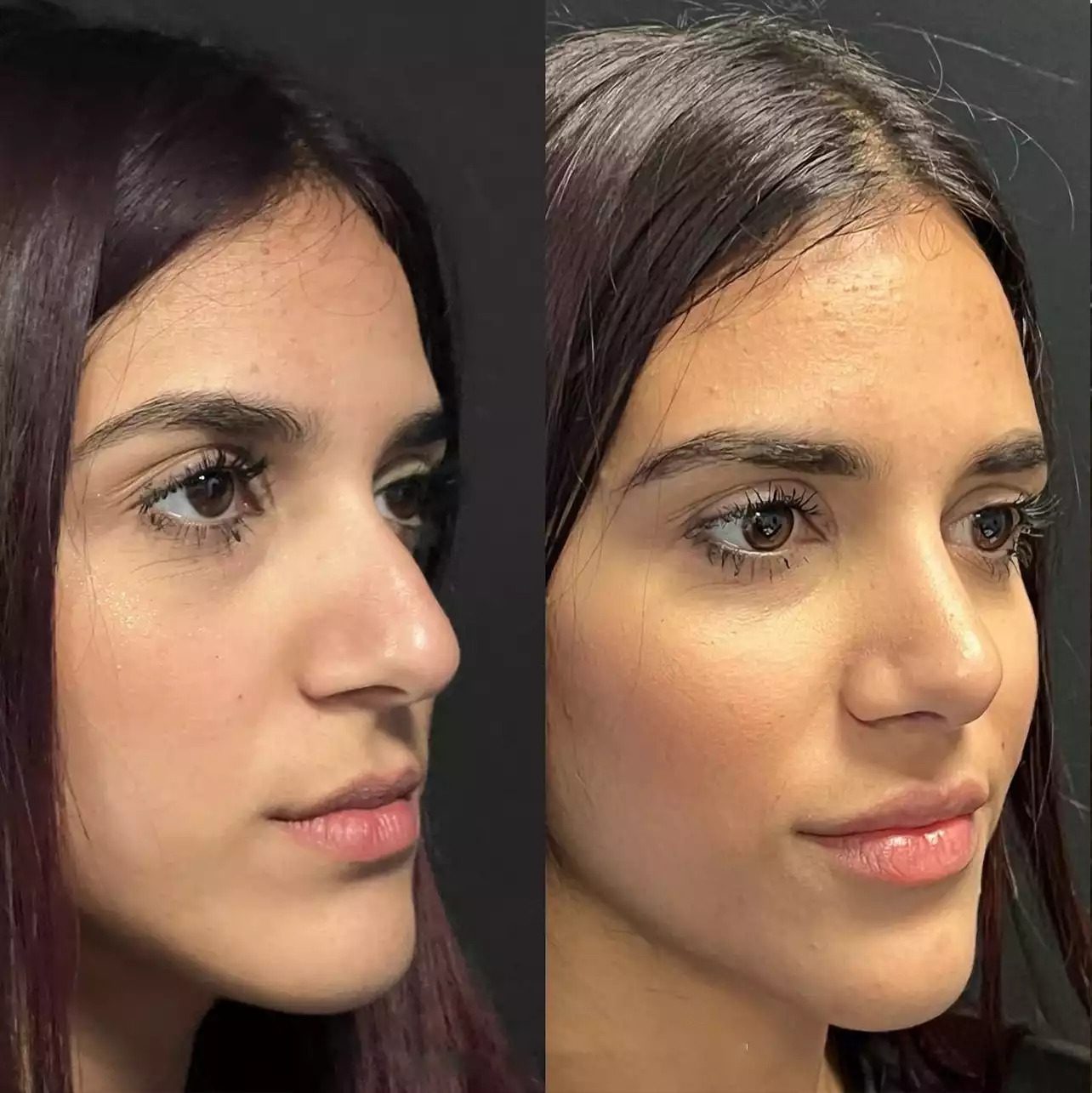 Choosing Septoplasty in Dubai: Everything You Need to Know