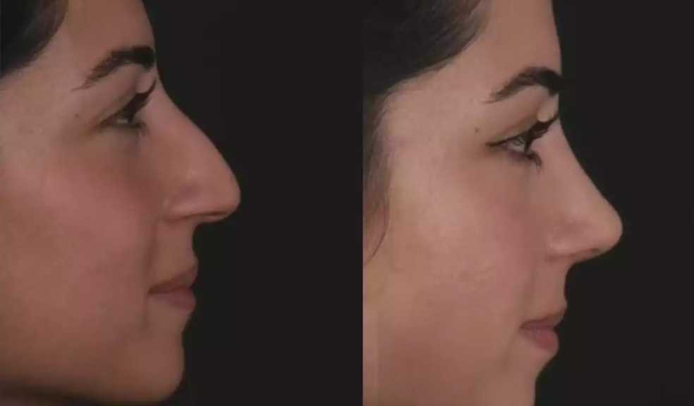 Get Back to Breathing Right with the Best Septoplasty Surgeons in Dubai