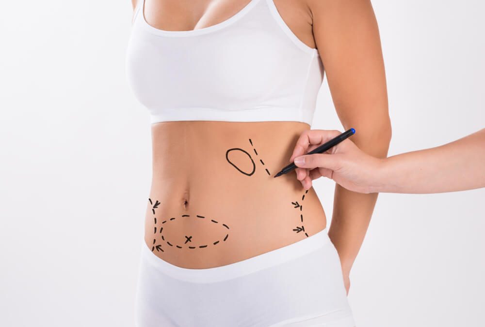 Nutrition & Fitness for Liposuction Recovery in Dubai