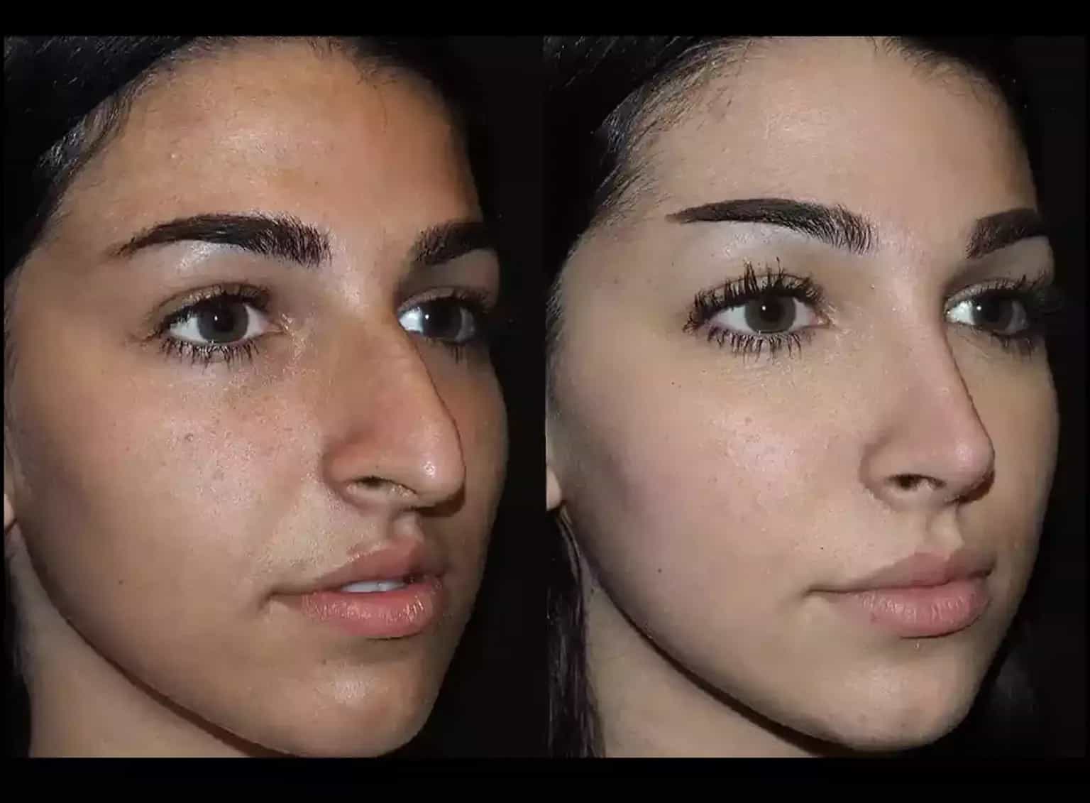 Minimally Invasive Nose Deviated Septum Surgery in Dubai: What’s New?