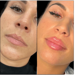 The Best Aesthetic Clinic in Dubai for Fillers: A Complete Overview