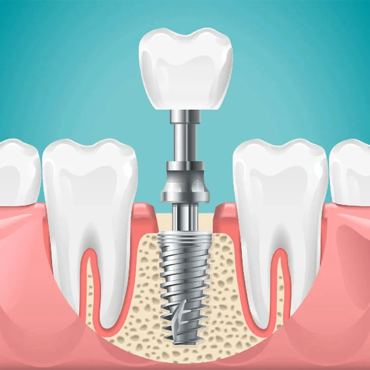 affordable-dental-implants
