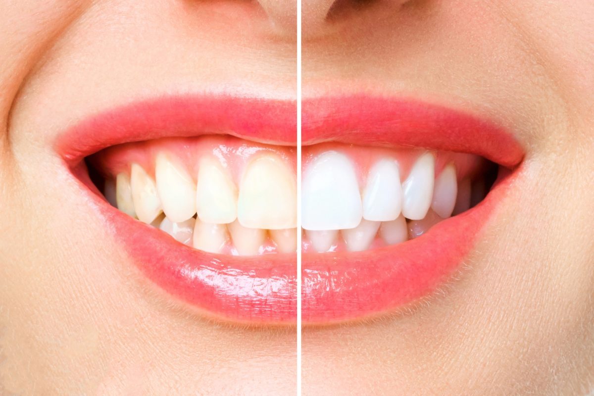 Why You Should See a Teeth Whitening Dentist in Texas for a Brighter Smile