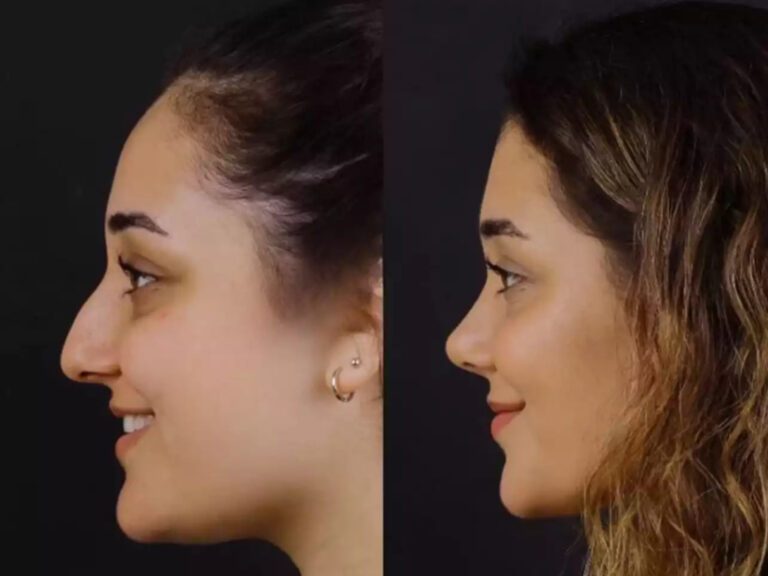 H-Rhinoplasty-8