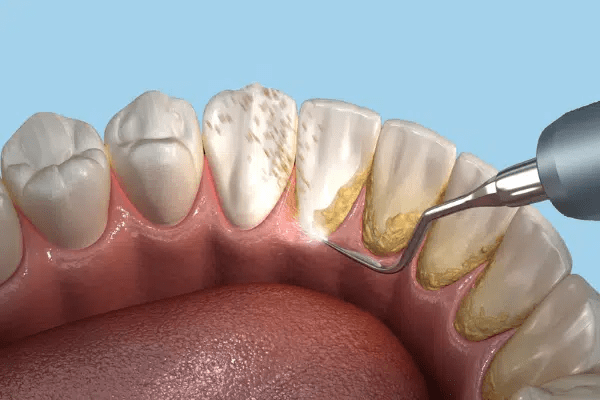 Why Regular Teeth Cleaning Near You Is Essential for a Healthy Smile