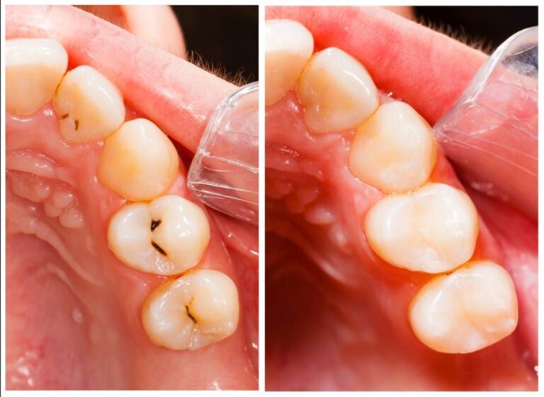 Composite-Tooth-Colored-Fillings.jpg.optimal