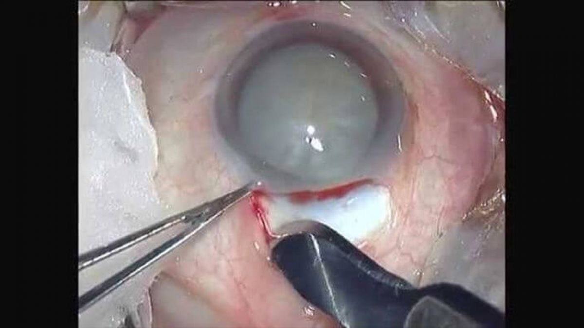 Clear Vision Starts Here: Sobti Nursing Home, the Best Cataract Hospital in Kurukshetra