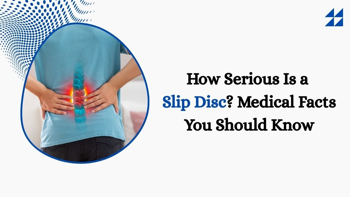 How Serious Is a Slip Disc? Medical Facts You Should Know