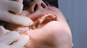 Dental Implants vs Dentures: What a Dentist in Pickering Recommends for Long-Term Oral Health
