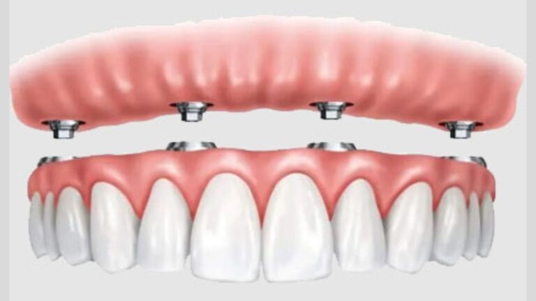 Full-Mouth-Dental-Implants