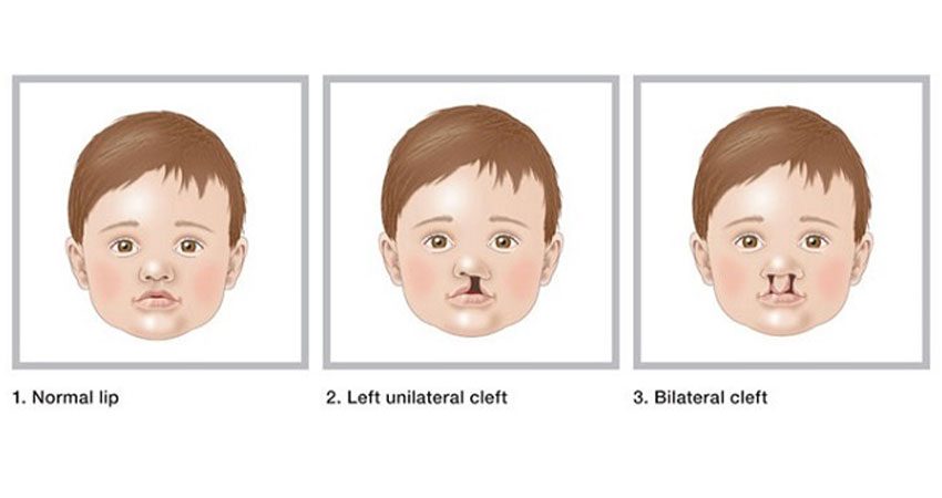Understanding Cleft Lip and Palate in India: Causes and Treatment Options