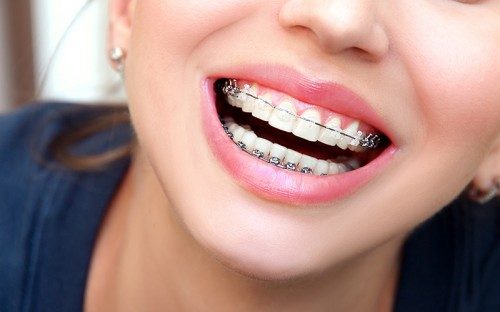 Common Bite Problems and How Orthodontic Treatment Fixes Them