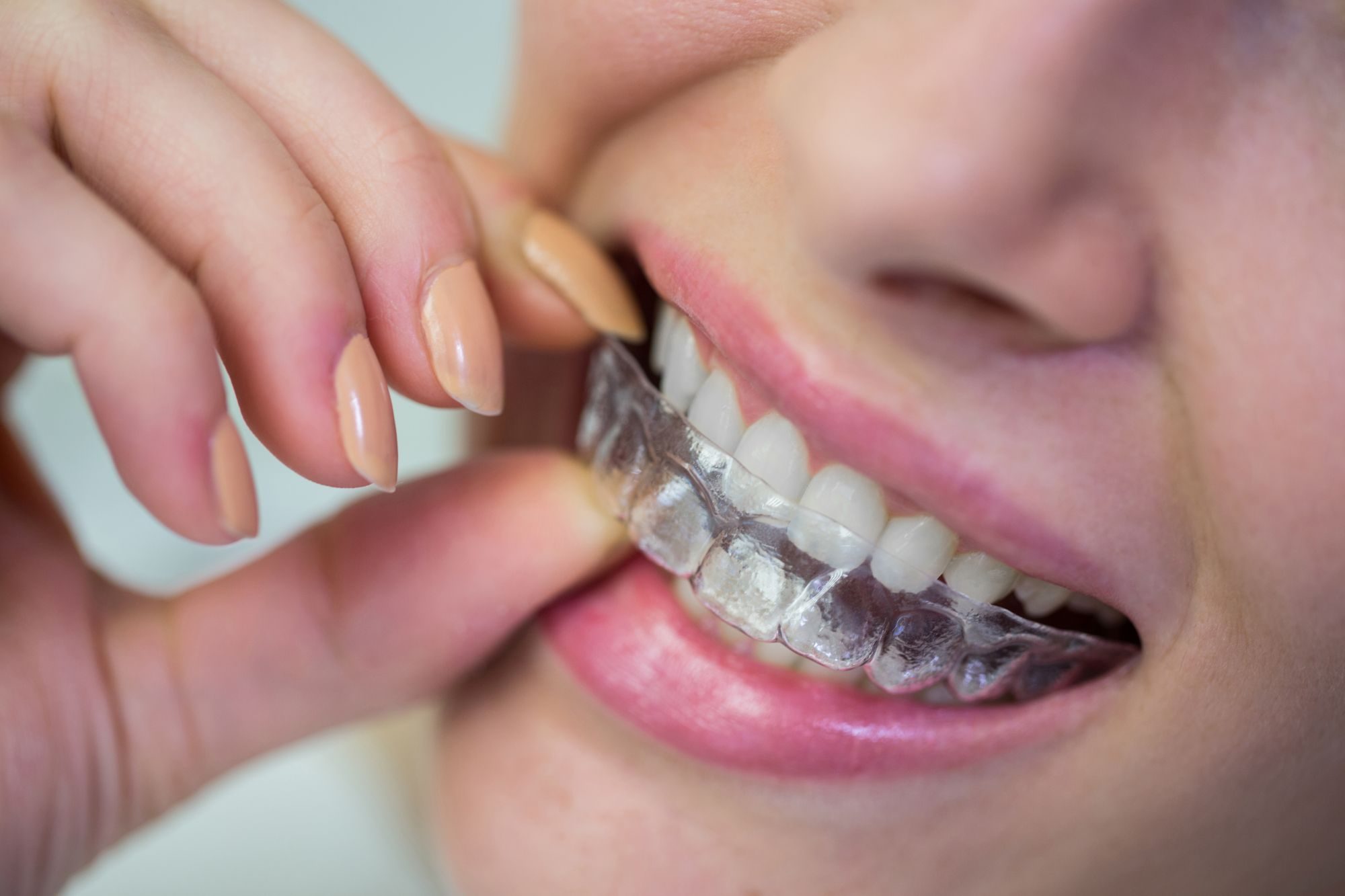 Braces Aligners Treatment Timeline: What to Expect During Every Stage