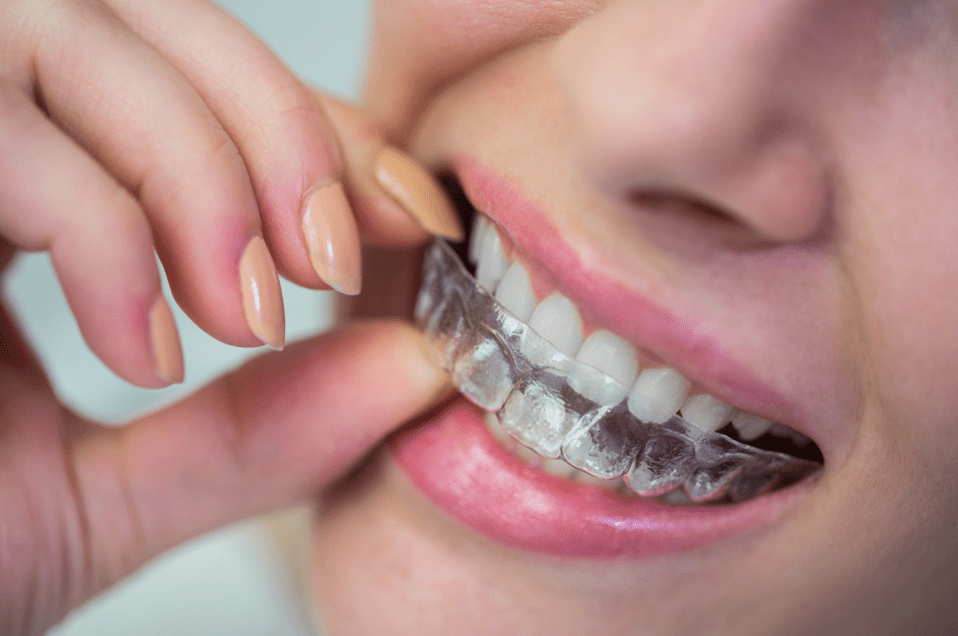 Why Is Invisalign Considered the Best Alternative to Braces Today?